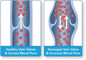 06 Healthy vs Diseased Vein Illustration