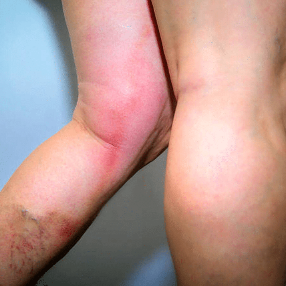 Leg With Thrombophlebitis