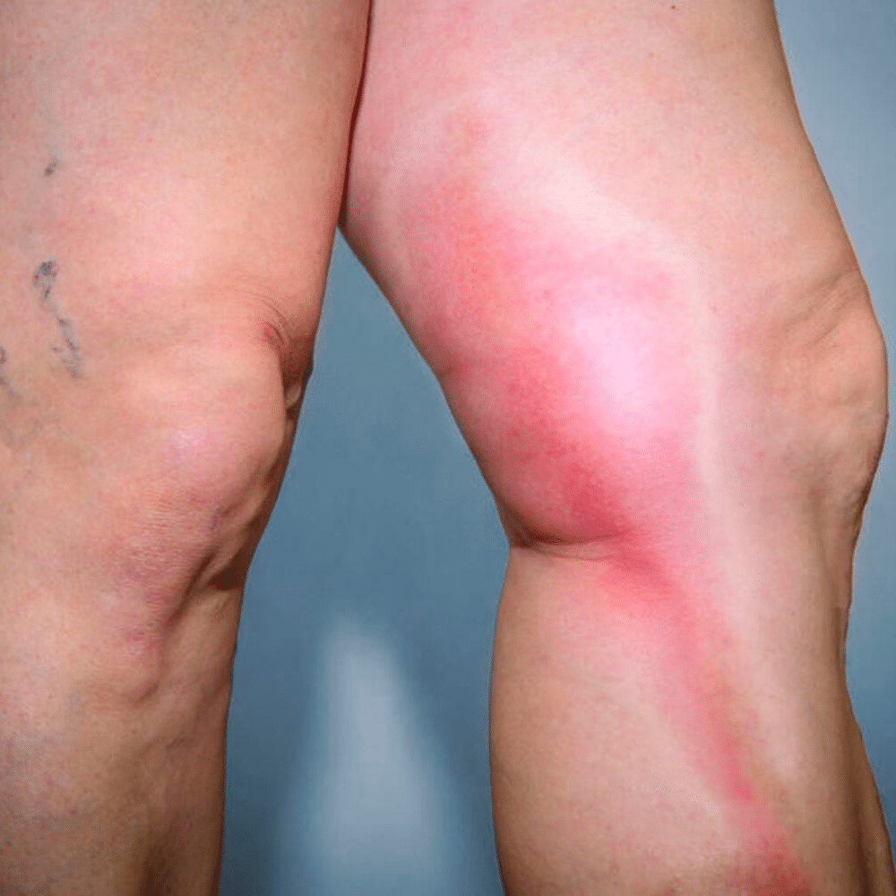 Leg with thrombophlebolic disease