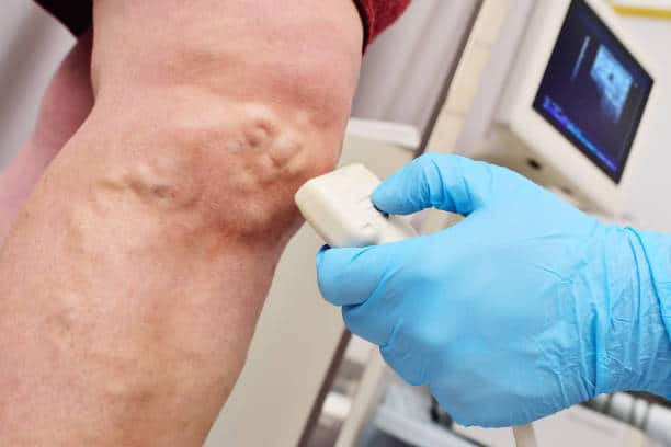examination of the patient's veins. Prevention of varicose veins
