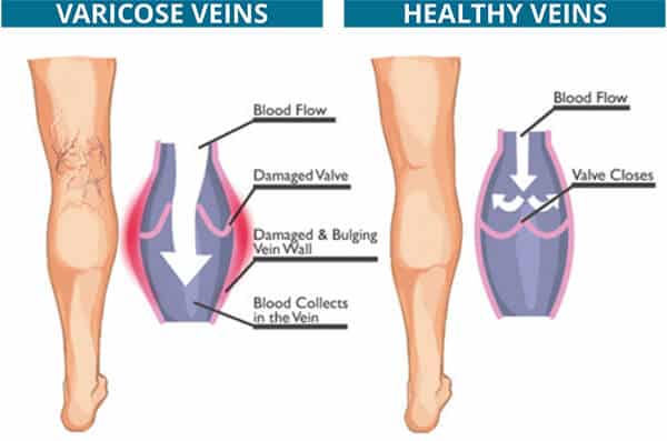 varicose veins