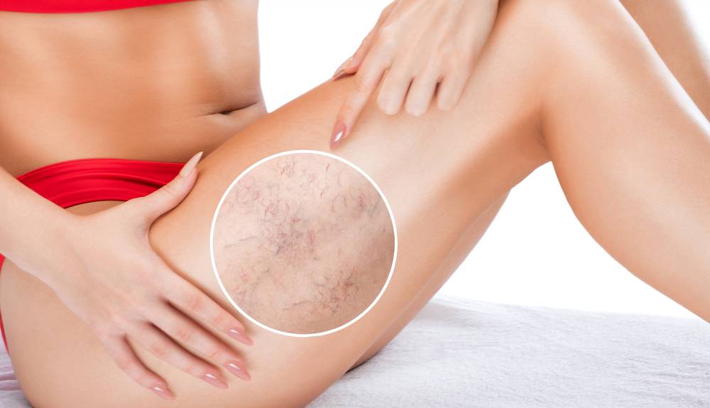 Sclerotherapy Munster IN