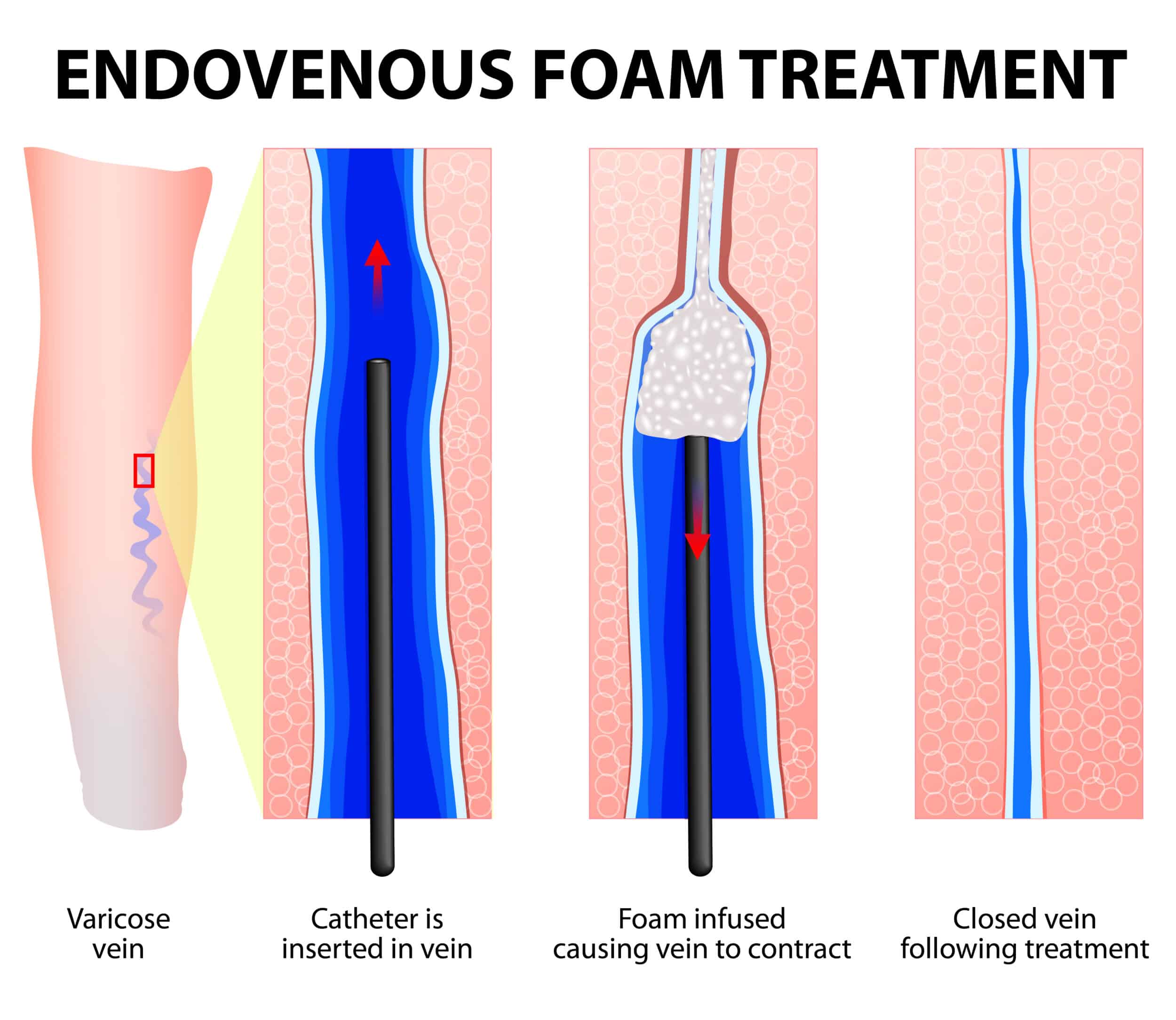 Artist's depiction of foam sclerotherapy to treat varicose vein