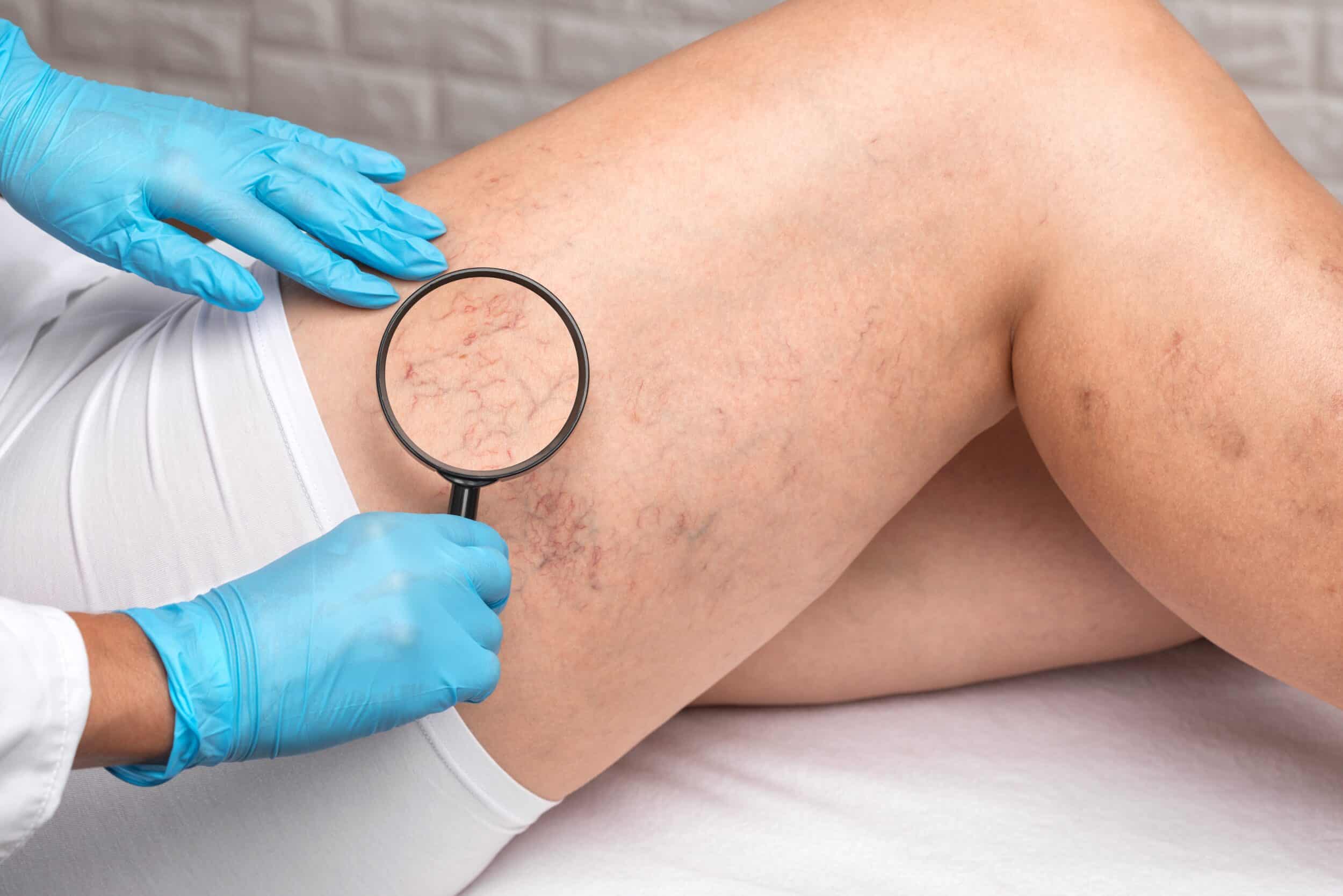 Doctor holds magnifying glass over spider veins on a patient's upper leg in Munster, IN