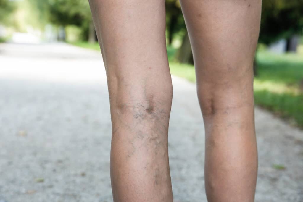 Woman with varicose veins walking down a gravel path as she plans a trip to visit her grandkids