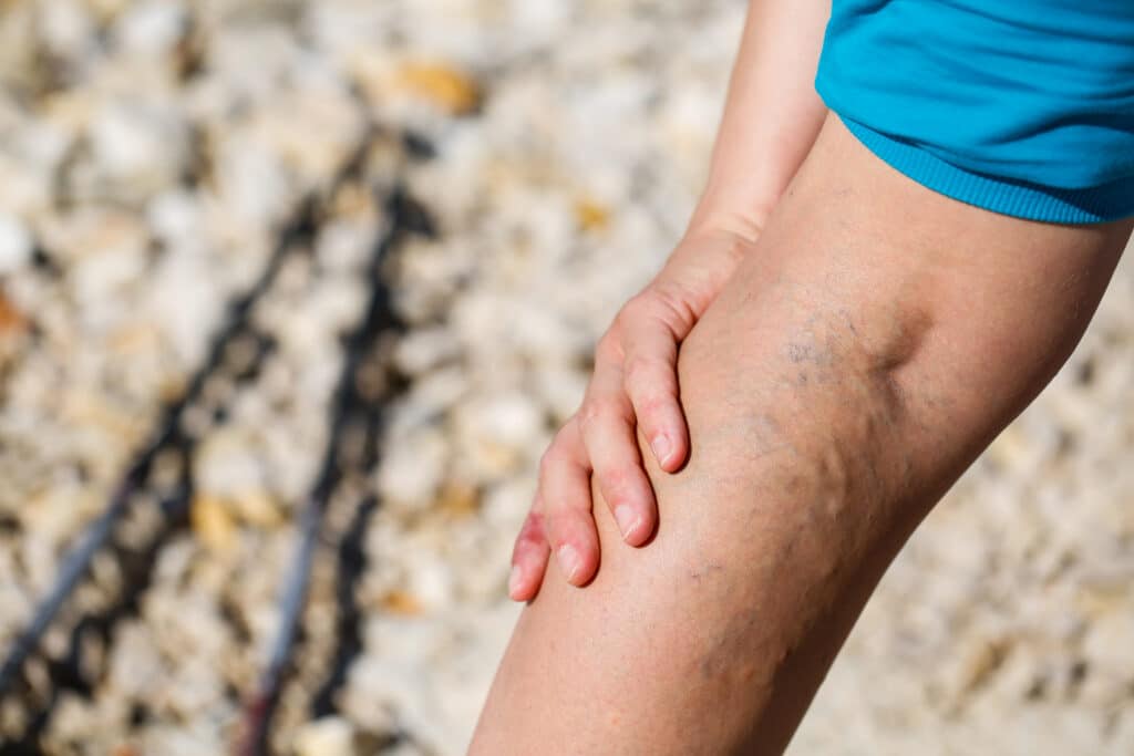Woman's leg, showing prominent veins, before her vein treatment