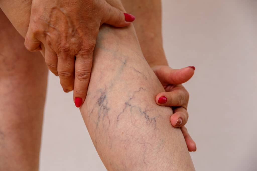 Woman examines her leg, showing signs of vein disease, before her diagnosis