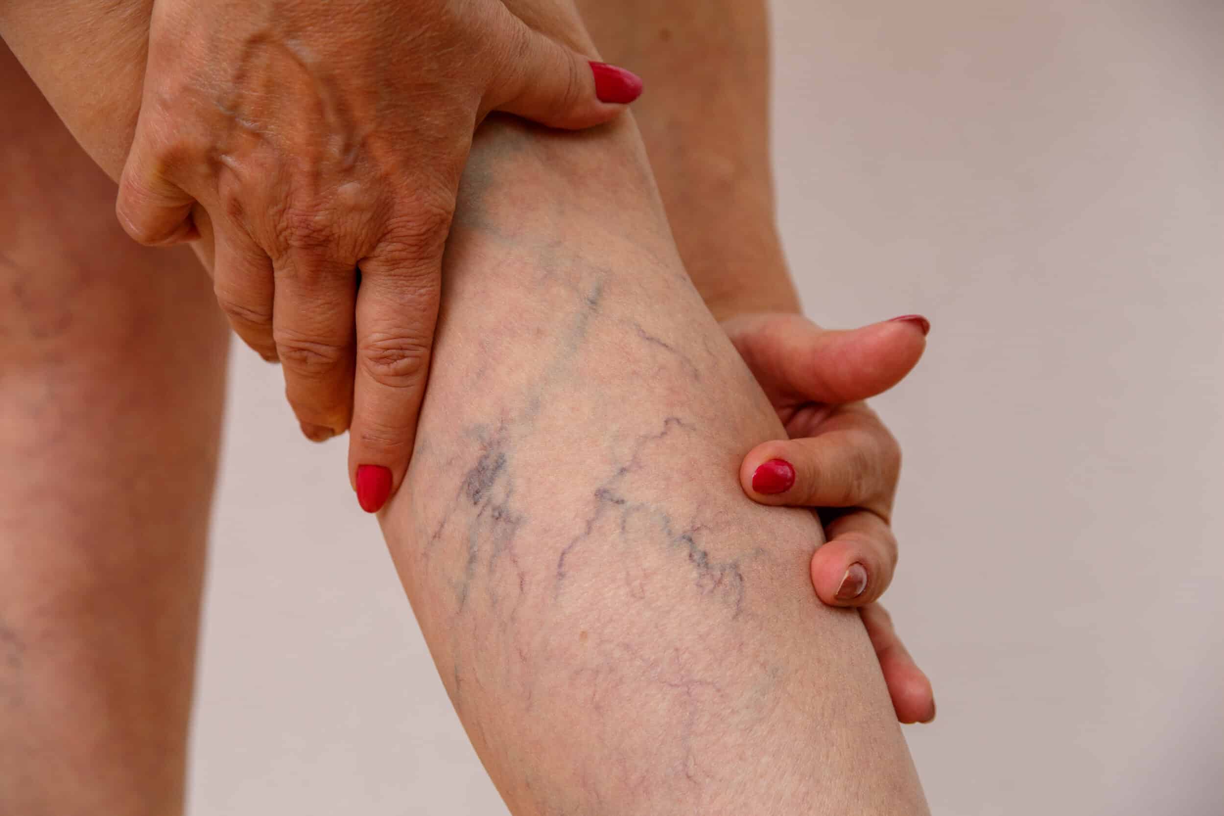 Woman examines her leg, showing signs of vein disease, before her diagnosis
