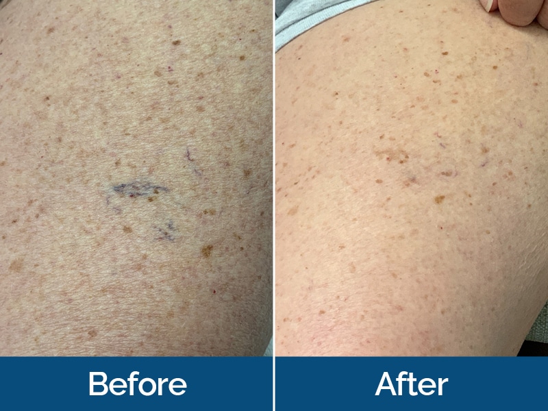 Before and After Image: Spider Veins - front