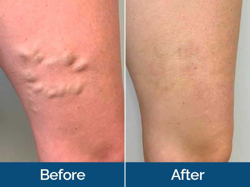 Before and After Image: Varicose Veins - front