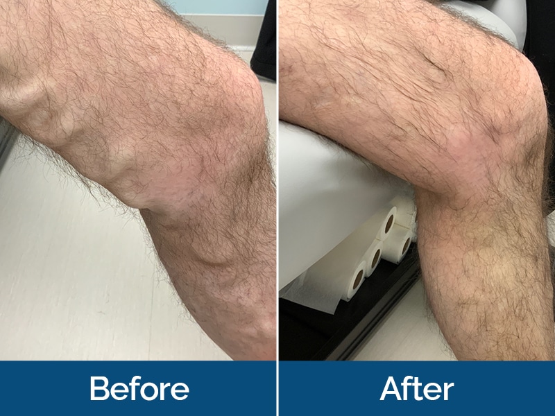 Before and After Image: Varicose Veins - right-side