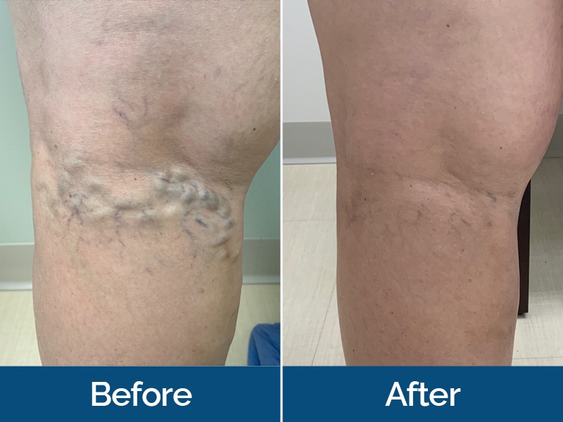 Before and After Image: Varicose Veins - back