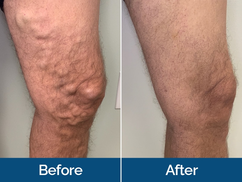 Before and After Image: Varicose Veins - front