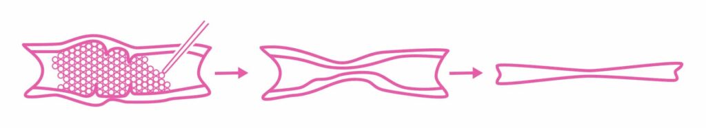 Varithena™ Varicose Vein Treatment in Munster, IN