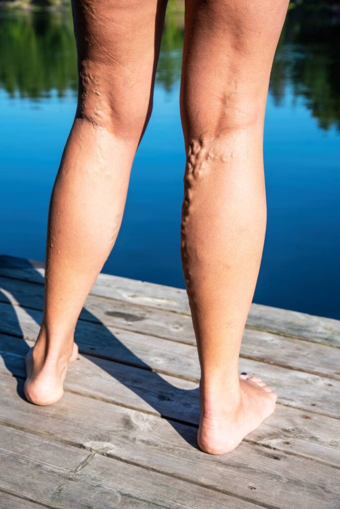 Varithena™ Varicose Vein Treatment in Munster, IN