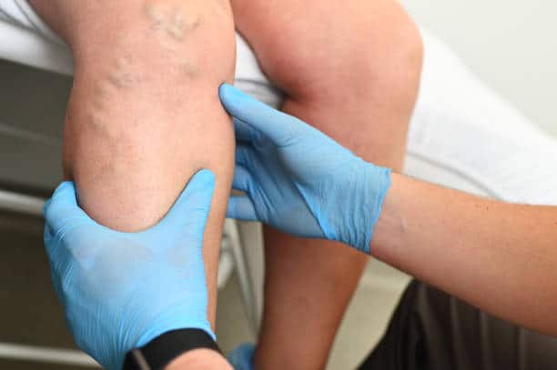 Vein Disease Diagnosis in Munster, IN