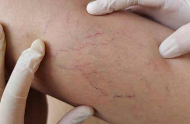 Vein Disease Diagnosis in Munster, IN