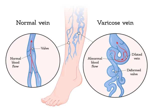 Varicose Vein Treatment in Munster, IN
