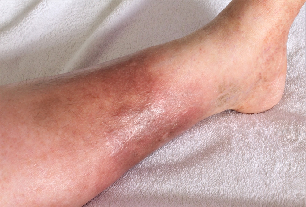 Chronic Venous Insufficiency (CVI) Treatment in Munster, IN
