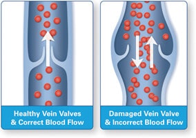 Chronic Venous Insufficiency (CVI) Treatment in Munster, IN
