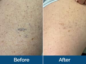 Vein Treatment Before & After