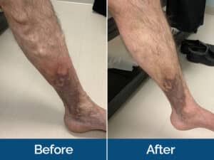 Vein Treatment Before & After