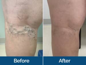 Vein Treatment Before & After