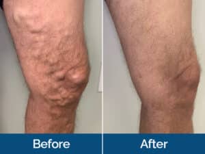 Vein Treatment Before & After