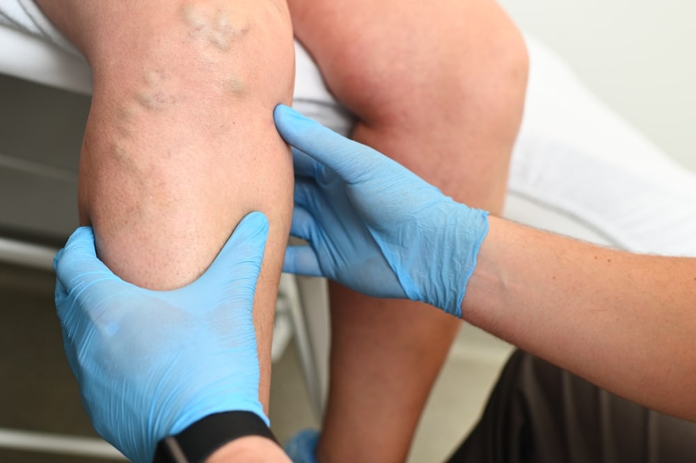 Doctor examines a woman's varicose veins in an office in Munster, IN