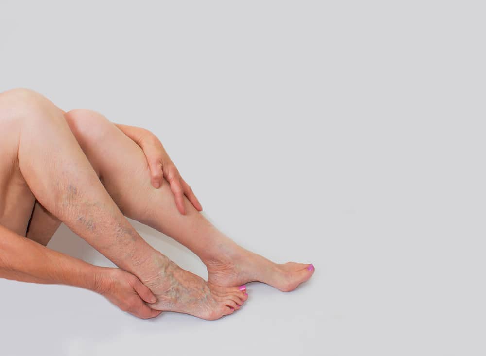 Woman showing varicose veins on her leg.